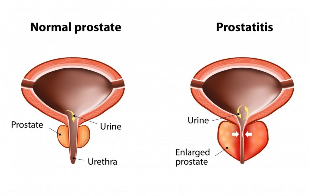 Understanding and Improving Prostate Health