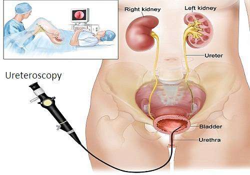 Ureteroscopy for Kidney Stones Treatment,Ureteroscopic ...