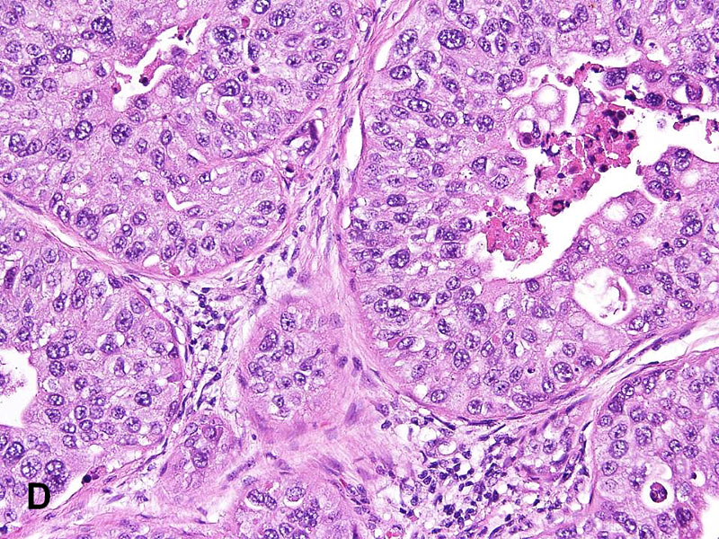 Urothelial Carcinoma of the Prostate