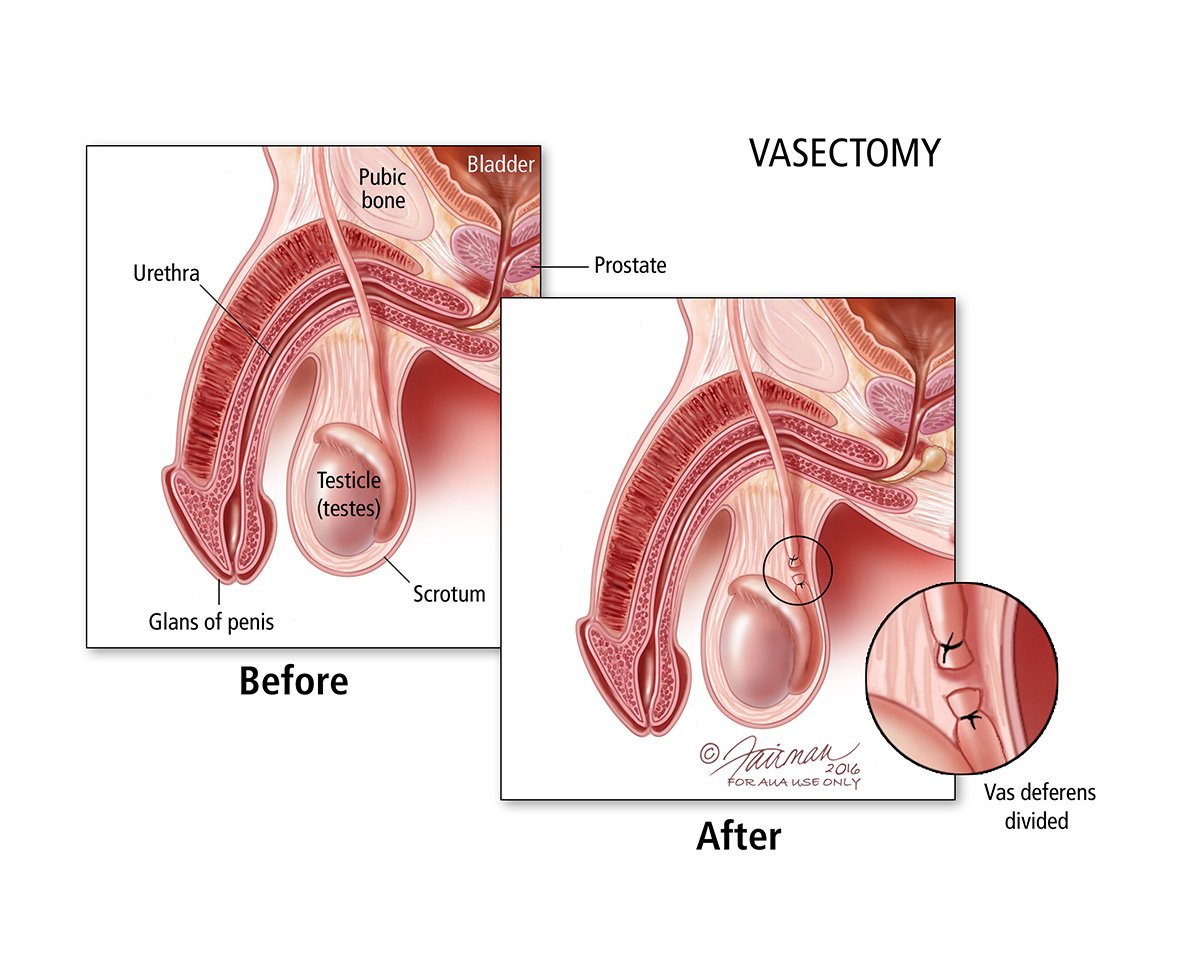 Vasectomy Reversal: Treatment & Information