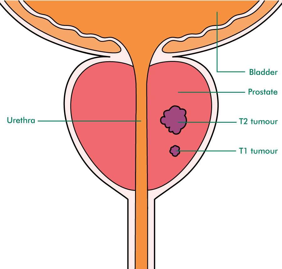 What Are The Stages Of Prostate Cancer