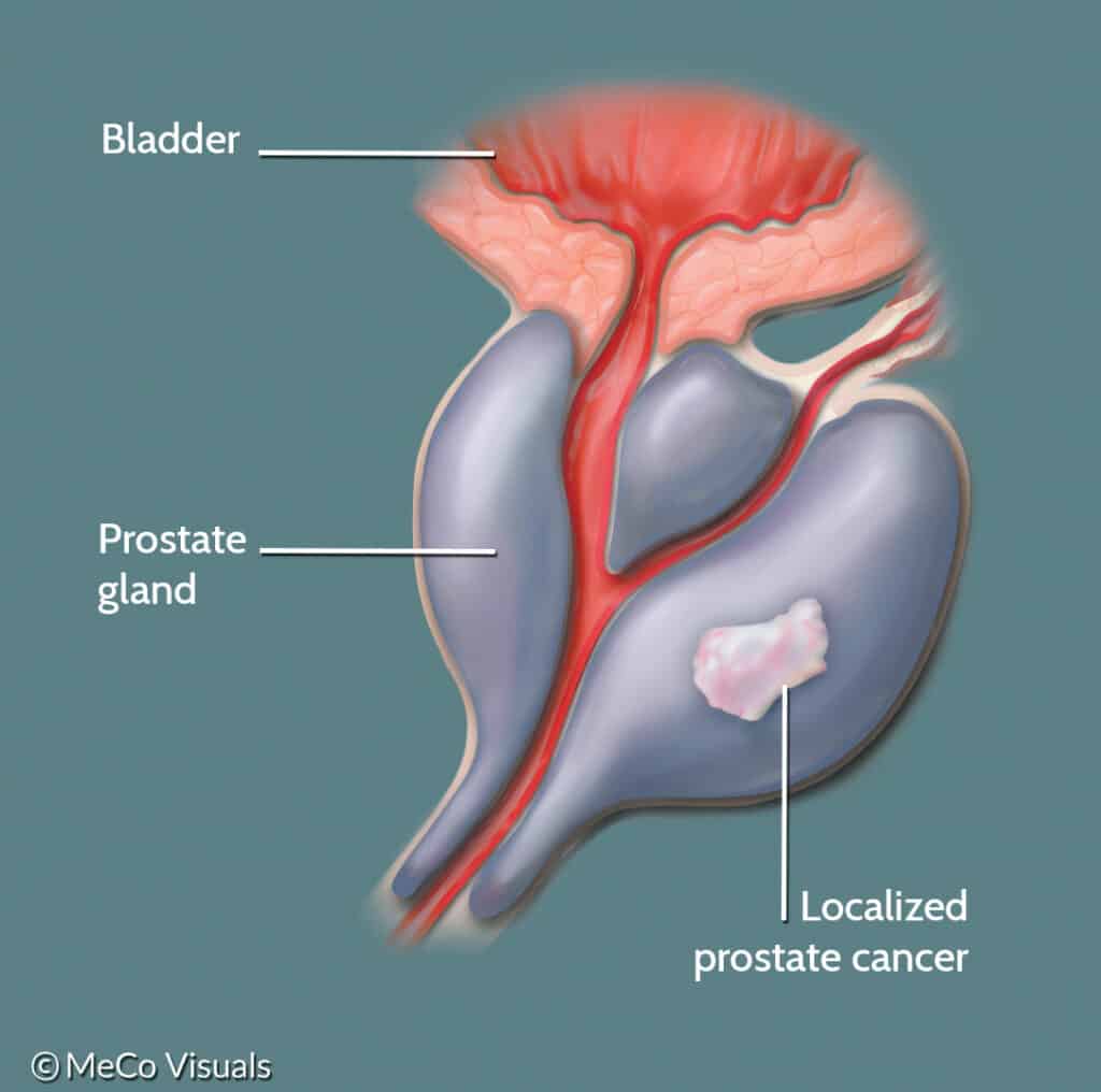 What Are The Symptoms Of Advanced Prostate Cancer / Prostate Cancer ...