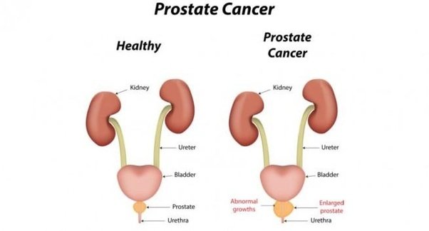 What are the symptoms of prostate cancer in men?