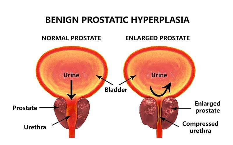What Happens If You Have Prostate Cancer