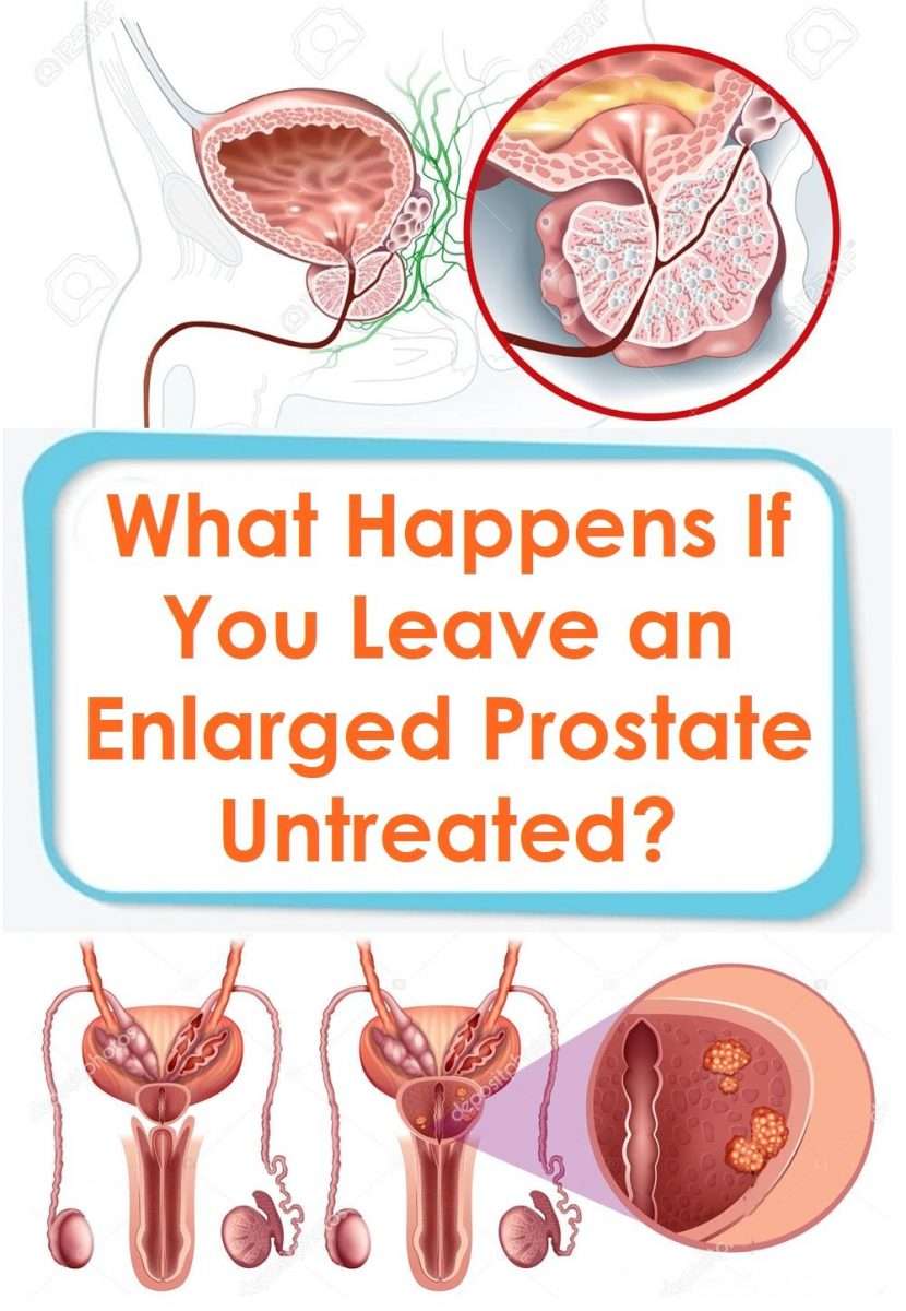 What Happens If You Leave an Enlarged Prostate Untreated? in 2021 ...
