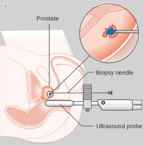 What is a transperineal prostate biopsy?