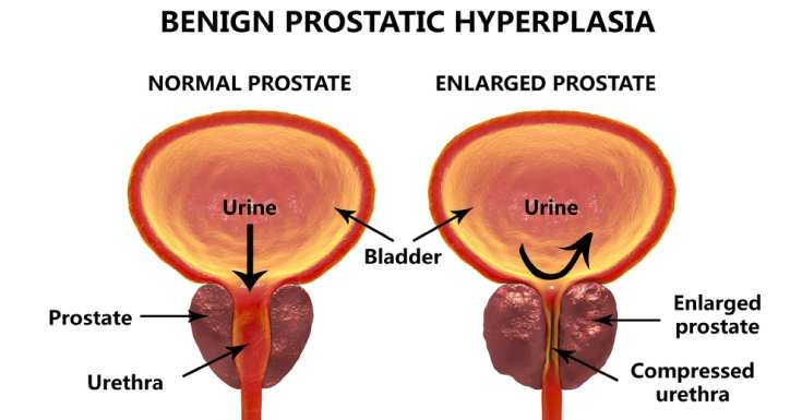 What is Enlarged Prostate