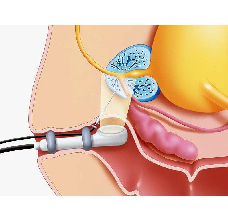 What is prostate biopsy?