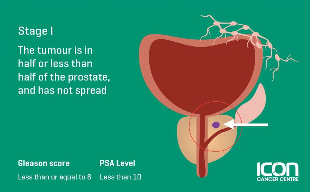 What is Prostate Cancer? Prostate Cancer explained