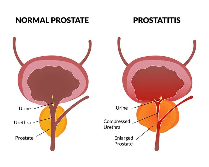 What is Prostatitis and How do you Treat It?