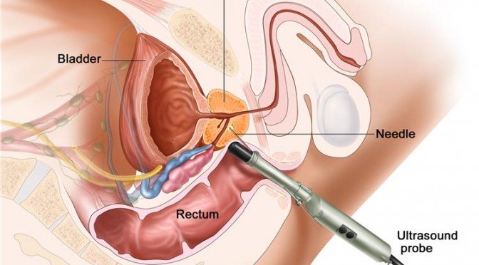 What to Expect After Your Prostate Biopsy?