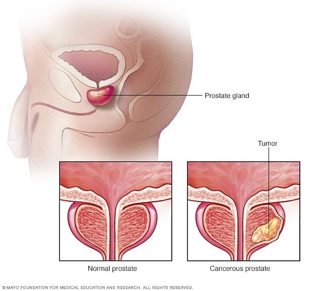 What You Should Know About Prostate Cancer
