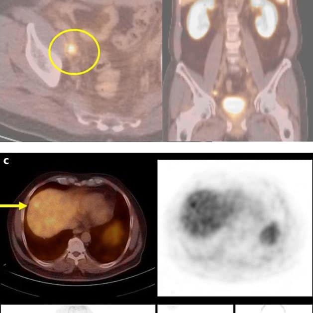 Will Prostate Cancer Show Up On A Pet Scan