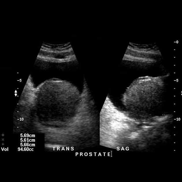 WK 6 PROSTATE Benign prostatic hypertrophy