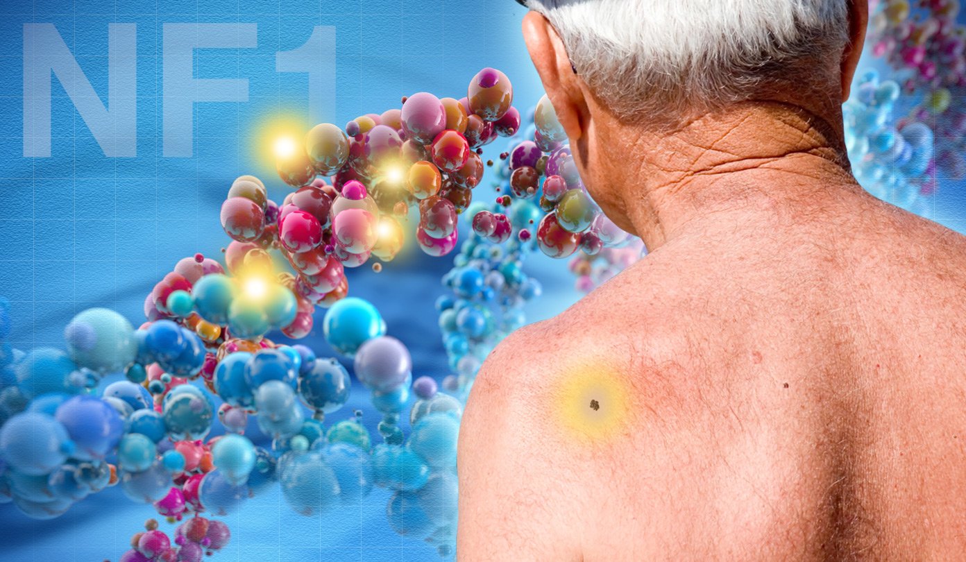 Yale study identifies major player in skin cancer genes ...